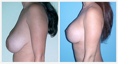 mamoplastia de reducción