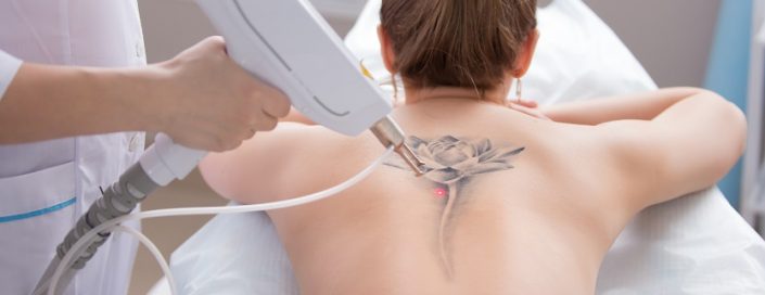 Eliminación de tatuajes con láser q-switched