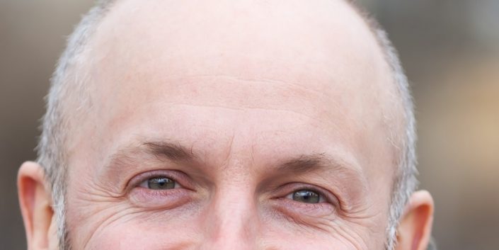 Solución a la calvicie y las canas Solución a la calvicie y las canas